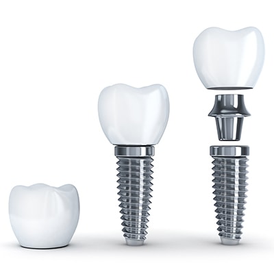 The anatomy of a dental implant: post, abutment, and crown.