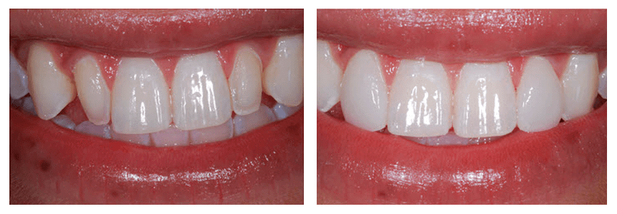 Before and After photos of a smile with porcelain veneers